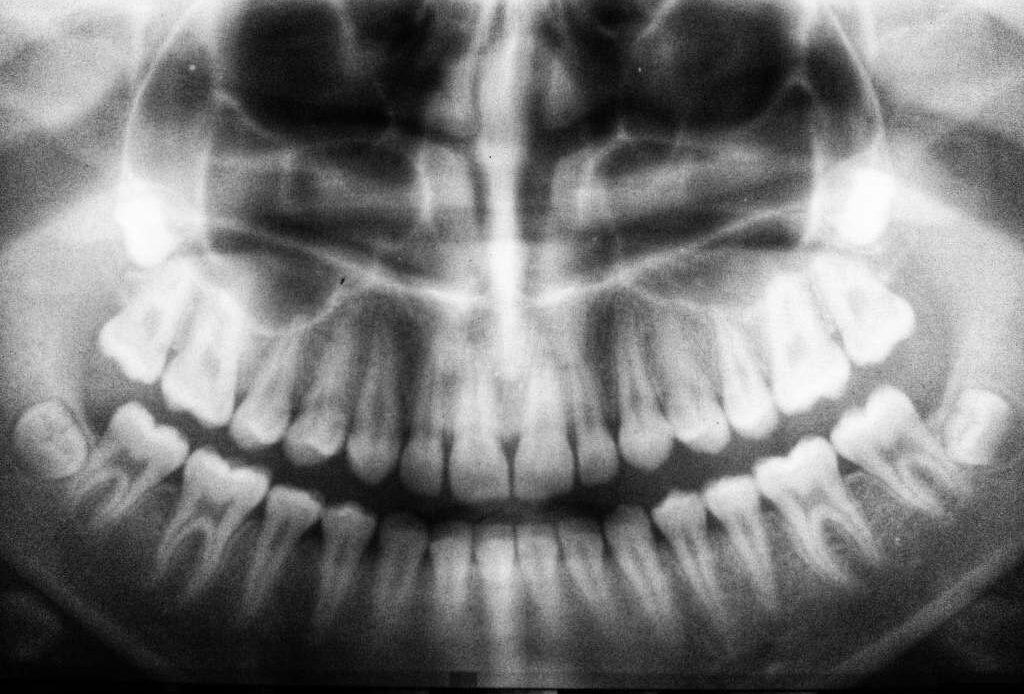 Opiate Addiction Treatment Can Cause Dental Issues: Understanding the Suboxone Lawsuit